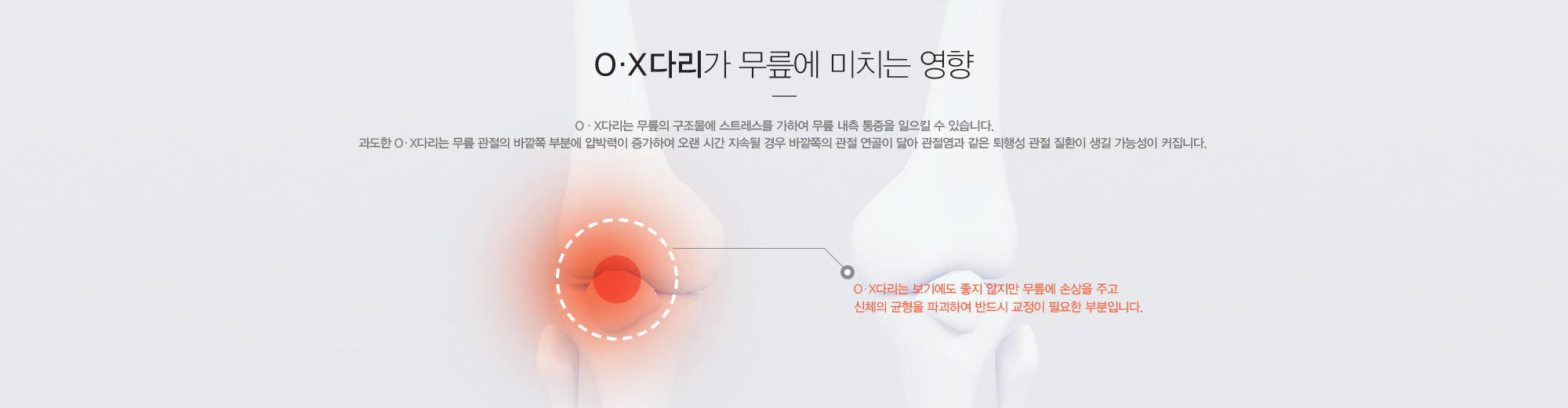 O,X 다리가 무릎에 미치는 영향:O,X다리는 무릎의 구조물에 스트레스를 가하여 무릎 내측 통증을 일으킬 수 있습니다. 과도한 O,X다리는 무릎관절의 바깥쪽 부분에 압박력이 증가하여 오랜시간 지속될 경우 바깥쪽의 관절연골이 닳아 관절염과 같은 퇴행성 관절질환이 생길 가능성이 커집니다.