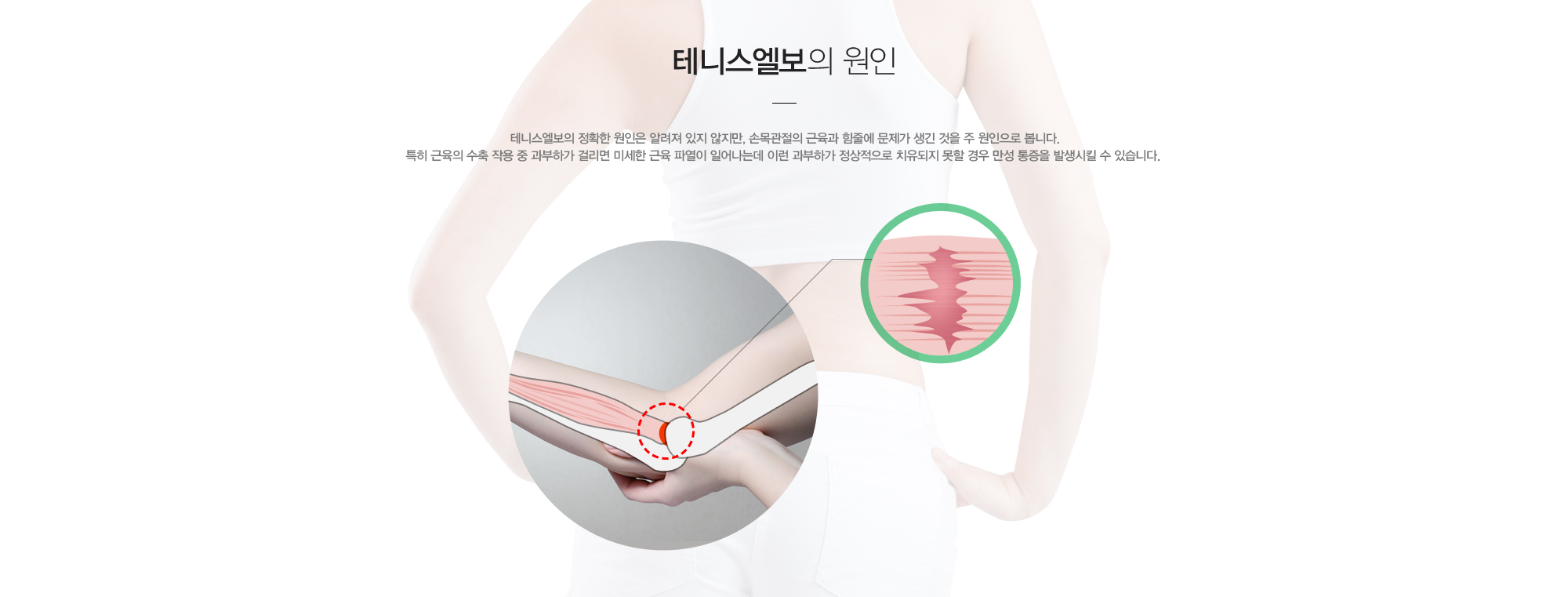 테니스 엘보의 원인 테니스엘보의 정확한 원인은 알려져 있지 않지만, 손목관절의 근육과 힘줄에 문제가 생긴 것을 주 원인으로 봅니다. 특히 근육의 수축 작용 중 과부하가 걸리면 미세한 근육파열이 일어나는데 이런 과부하가 정상적으로 치유되지 못할 경우 만성 통증을 발생시킬 수 있습니다.