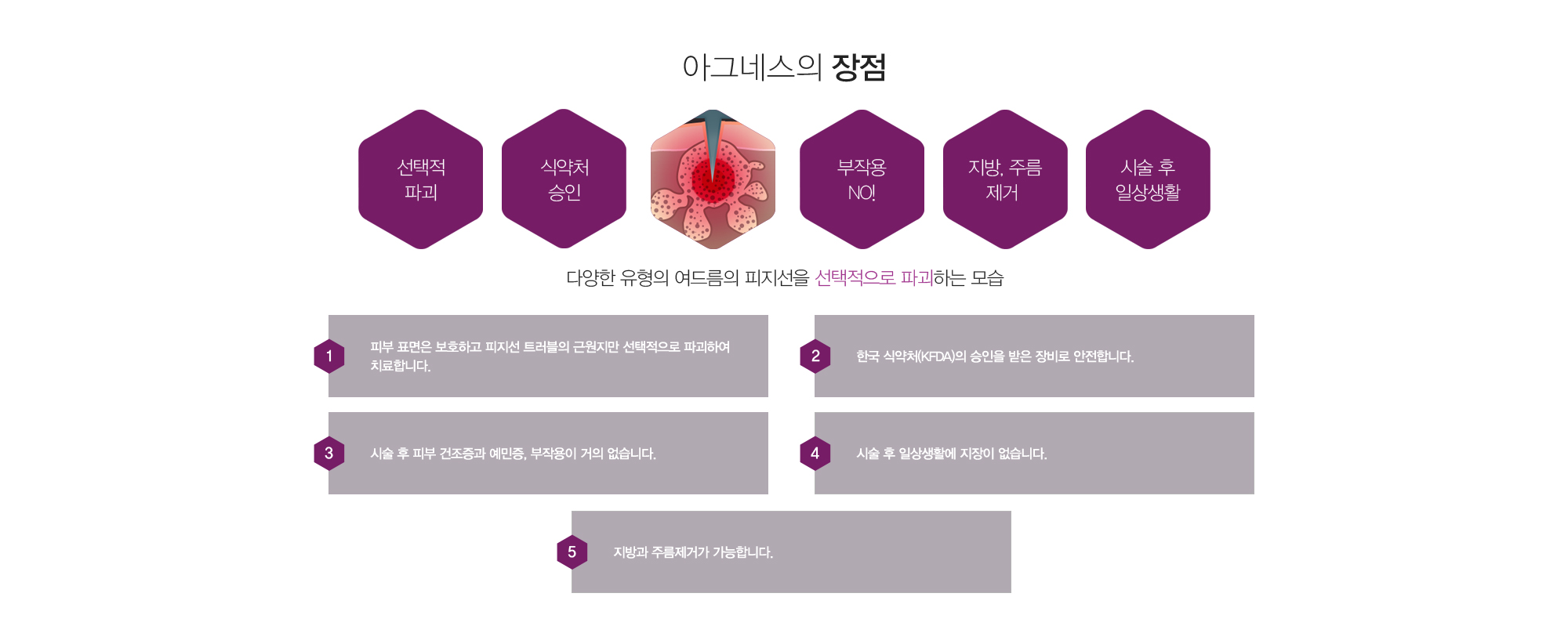 아그네스의 장점:선택적 파괴,식약처승인,부작용NO!,시술후일상생활 다양한 유형의 여드름의 피지선을 선택적으로 파괴하는 모습 1)피부 표면은 보호하고 피지선 트러블의 근원지만 선택적으로 파괴하여 치료합니다. 2)한국 식약처(KFDA)의 승인을 받은 장비로 안전합니다. 3)시술 후 피부 건조증과 예민증, 부작용이 거의 없습니다. 4)시술 후 일상생활에 지장이 없습니다.