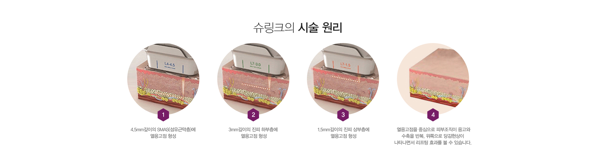 슈링크의 시술 원리:1)4.5mm깊이의 SMAS(섬유근막층)에 열응고점 형성 2)3mm깊이의 진피 하부층에 열응고점 형성 3)1.5mm깊이의 진피 상부층에 열응고점 형성 4)열응고점을 중심으로 피부조직이 응고와 수축을 반복, 위쪽으로 당김현상이 나타나면서 리프팅 효과를 볼 수 있습니다.