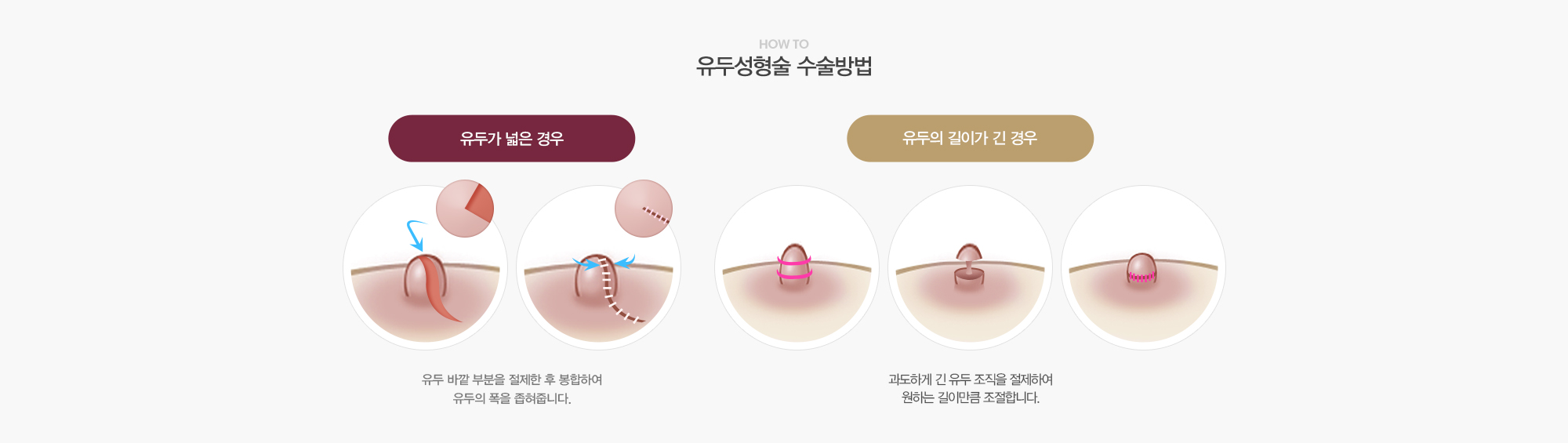 유두성형술 수술방법:유두가 넓은 경우-유두 바깥 부분을 절제한 후 봉합하여 유두의 폭을 좁혀줍니다./유두의길이가 긴경우-과도하게 긴 유두조직을 절제하여 원하는 길이만큼 조절합니다.