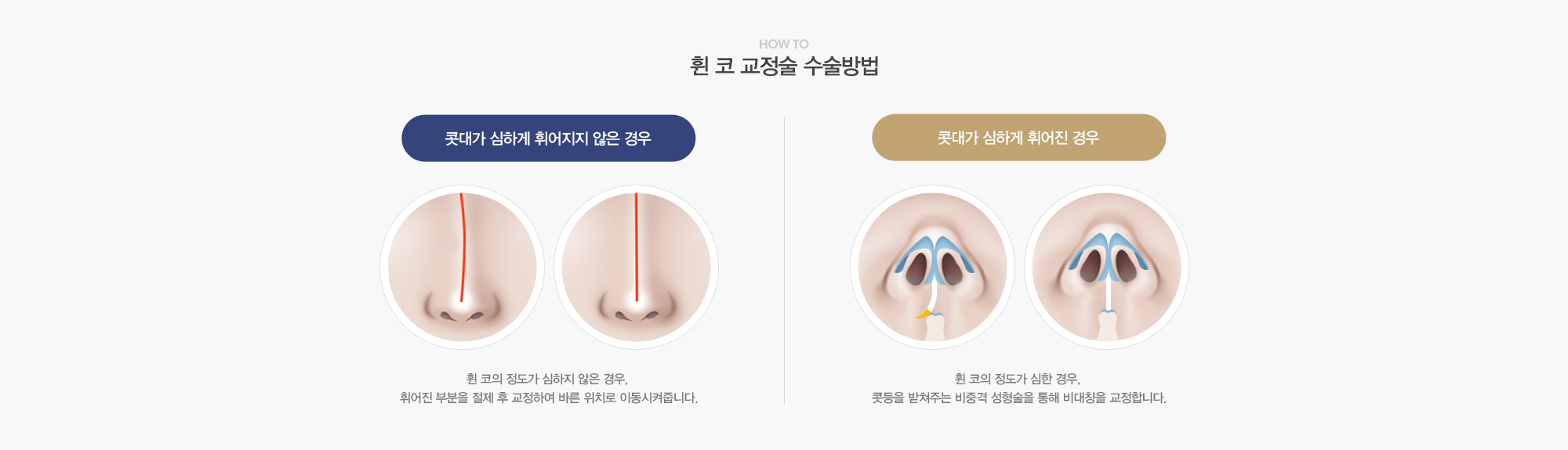 휜 코 교정술 수술방법:콧대가 심하게 휘어지지 않은 경우-휜코의 정도가 심하지 않은 경우, 휘어진 부분을 절제 후 교정하여 바른위치로 이동시켜줍니다. 콧대가 심하게 휘어진 경우-휜코의 정도가 심한 경우, 콧등을 받쳐주는 비중격 성형술을 통해 비대칭을 교정합니다.