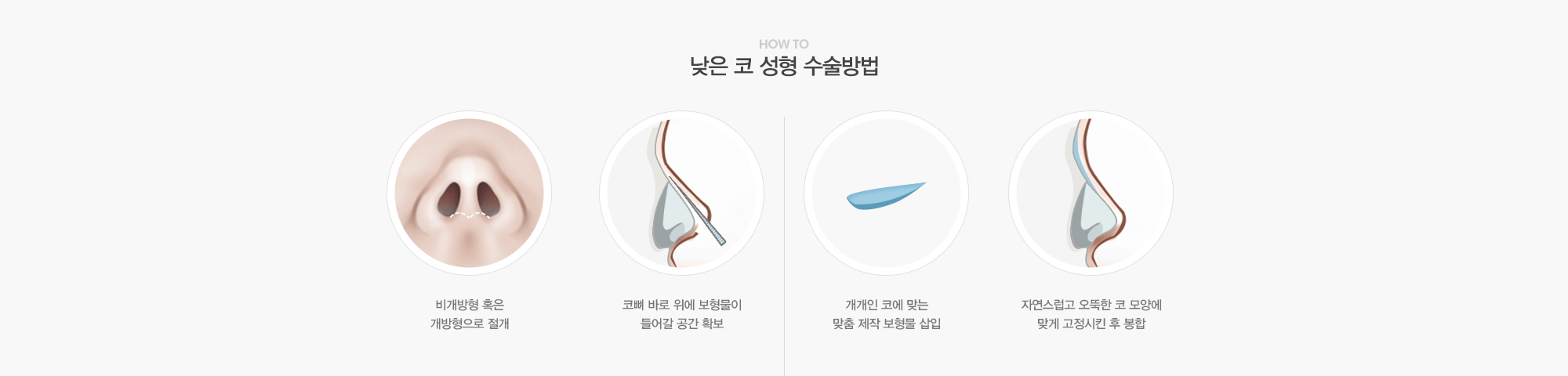 낮은 코 성형 수술방법:비개방형 혹은 개방형으로 절개,코뼈 바로 위에 보형물이 들어갈 공간 확보,개개인 코에 맞는 맞춤제작 보형물 삽입,자연스럽고 오똑한 코모양에 맞게 고정시킨 후 봉합