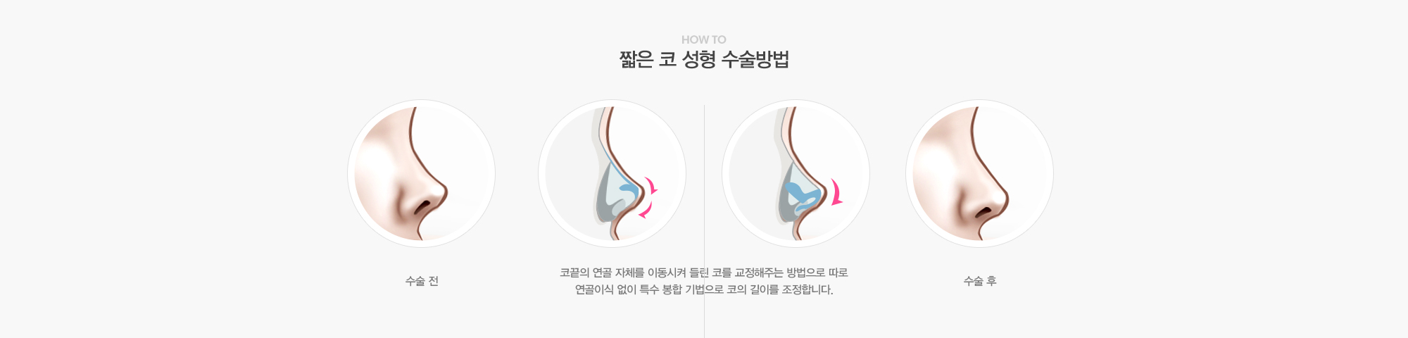 짧은 코 성형 수술방법:코끝의 연골 자체를 이동시켜 들린 코를 교정해주는 방법으로 따로 연골이식 없이 특수봉합기법으로 코의 길이를 조정합니다. 