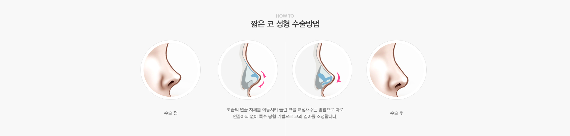 짧은 코 성형 수술방법:코끝의 연골 자체를 이동시켜 들린 코를 교정해주는 방법으로 따로 연골이식 없이 특수봉합기법으로 코의 길이를 조정합니다. 