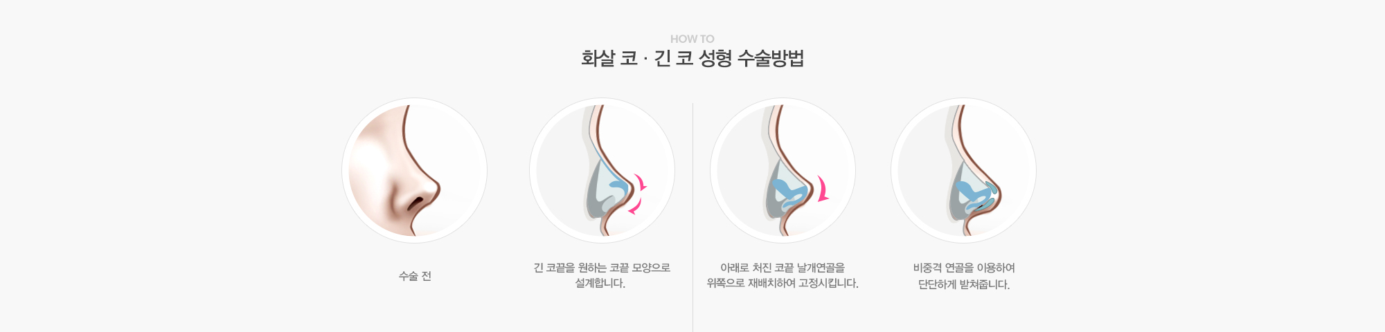 화살 코·긴 코 성형 수술방법:긴 코끝을 원하는 코끝 모양으로 설계합니다.-아래로 처진 코끝 날개연골을 위쪽으로 재배치하여 고정시킵니다.-비중격연골을 이용하여 단단하게 받쳐줍니다.